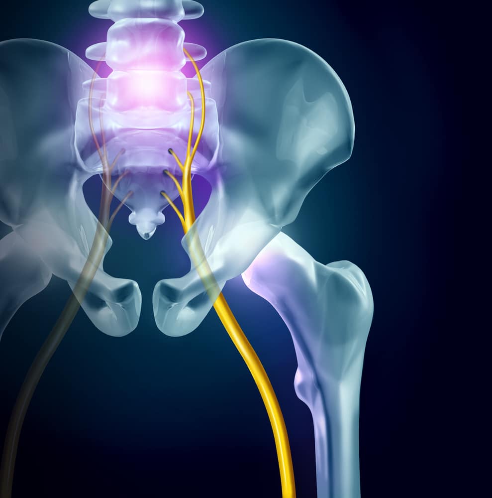 sciatica Elite Chiropractic