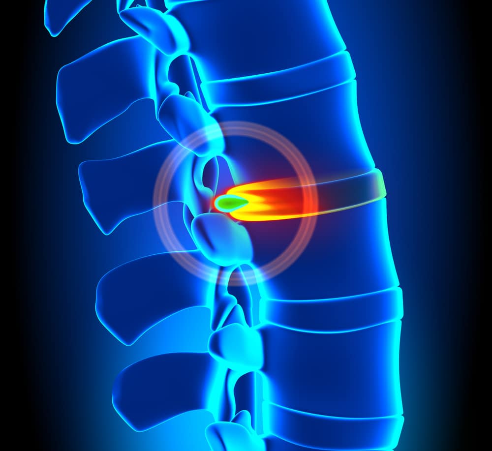 How Do You Know If You Have A Herniated Disc? herniated disc