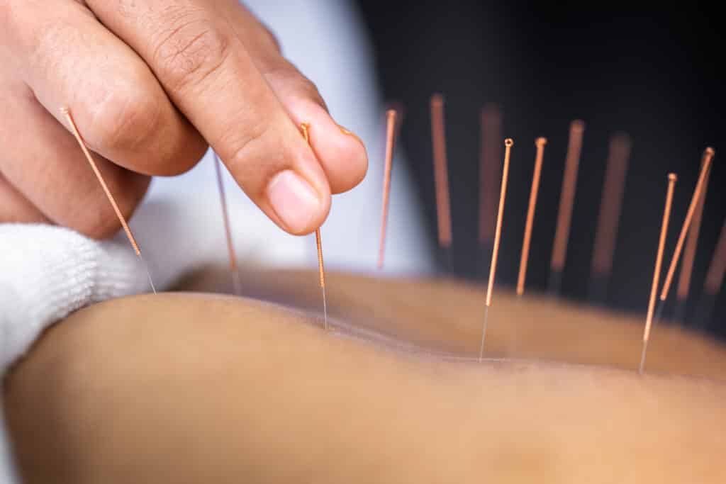 Should You Get Chiropractic Care Or Acupuncture? Chiropractic care or acupuncture in Wenatchee, WA